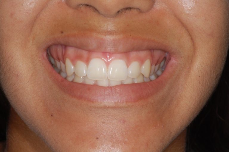 O Que Sorriso Gengival Dr Augusto Fernandes